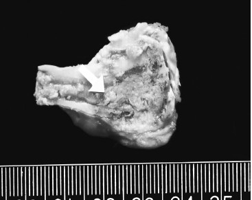 Coagulative necrosis and congestion rim surrounding ablated tissue Coagulative necrosis and congestion rim surrounding ablated tissue