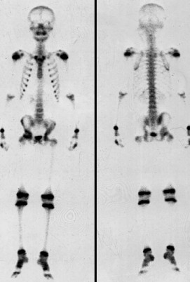 Fourteen days after high intensity focused ultrasound Fourteen days after high intensity focused ultrasound