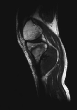Contrast-enhanced magnetic resonance image obtained fourteen days after high intensity focused ultrasound Contrast-enhanced magnetic resonance image obtained fourteen days after high intensity focused ultrasound